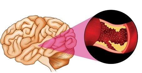 Brain Ischemia Market