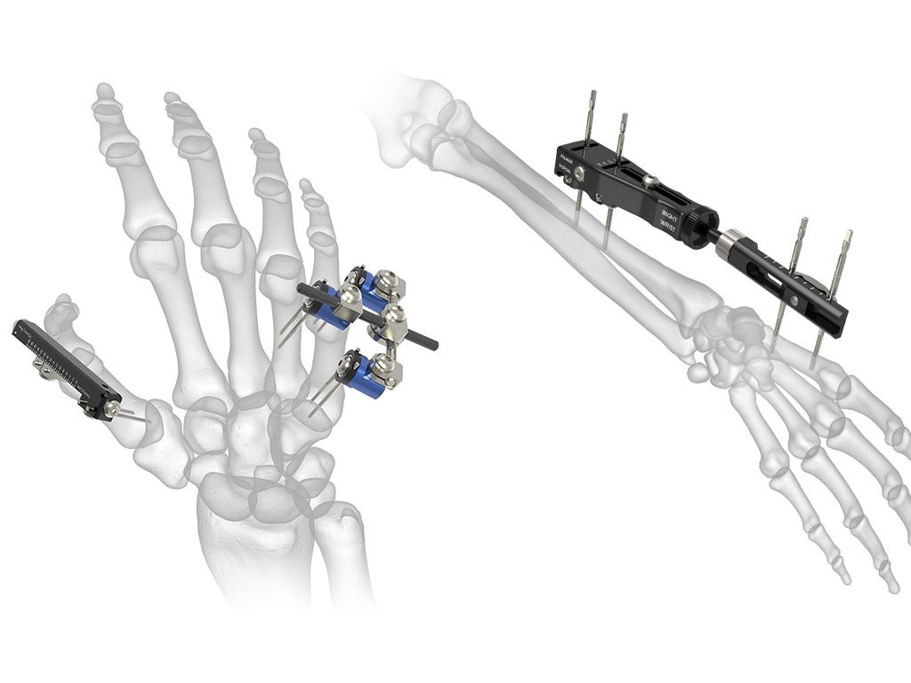 External Fixators Market