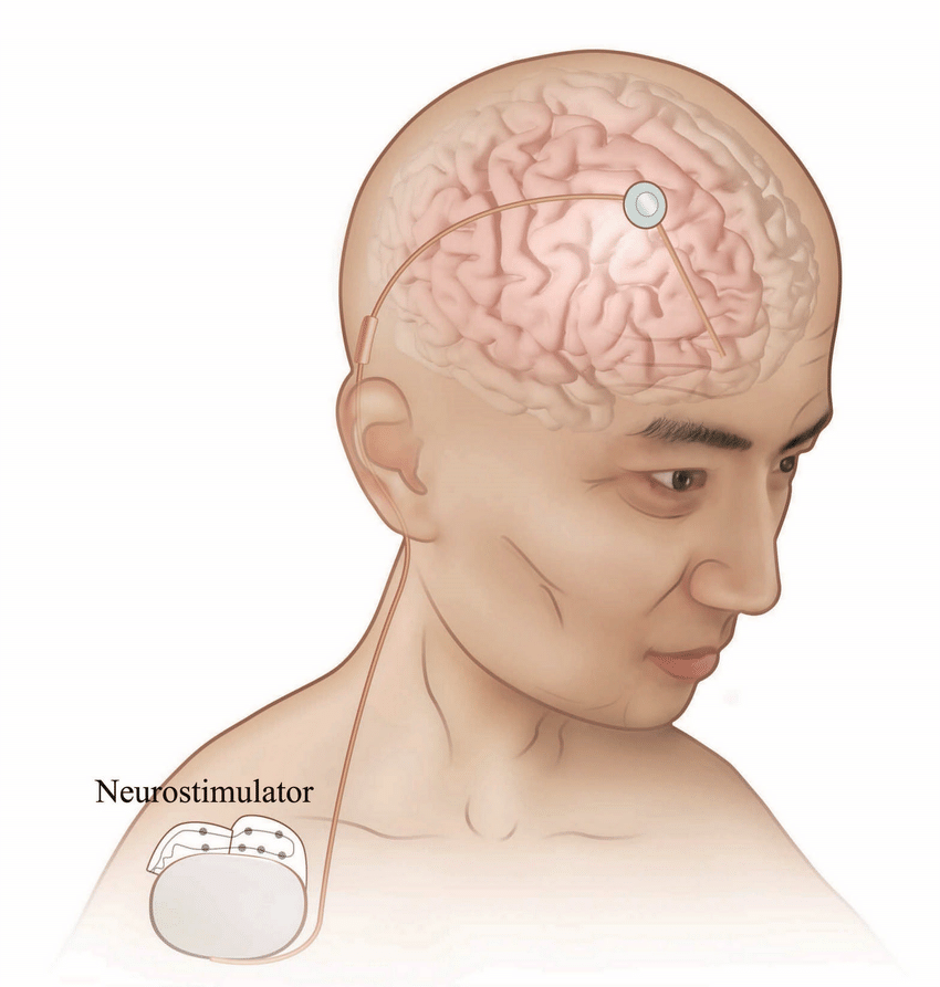 Implantable Neurostimulator Market