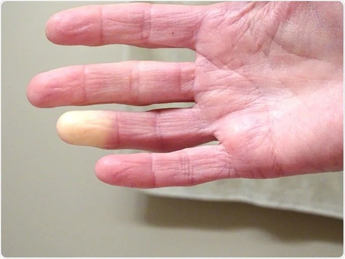 Raynauds Disease Treatment Market