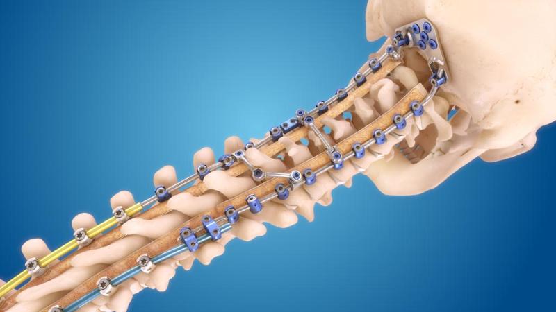 Spinal Implants & Devices Market